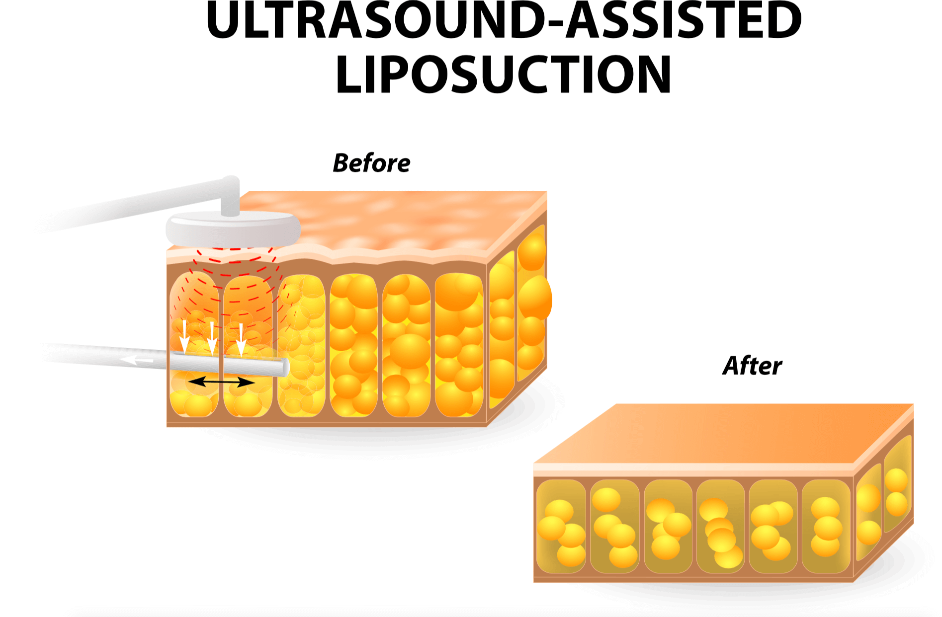 Vaser Lipo Ultrasound Assisted Liposuction Explained Δρ Νικόλαος